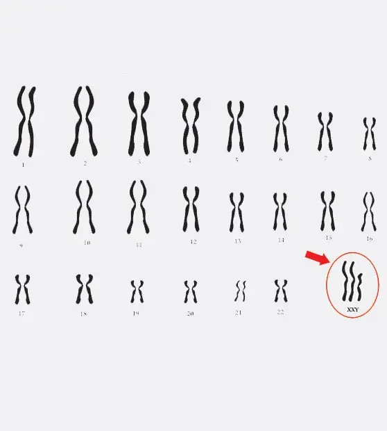 Klinefelter Syndrome and Infertility