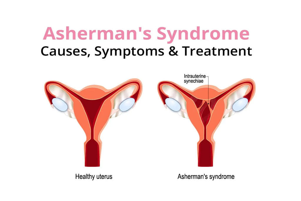 Ashermans Syndrome Causes Symptoms and Treatment