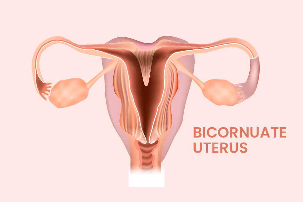 Bicornuate Uterus Causes Symptoms and Treatment