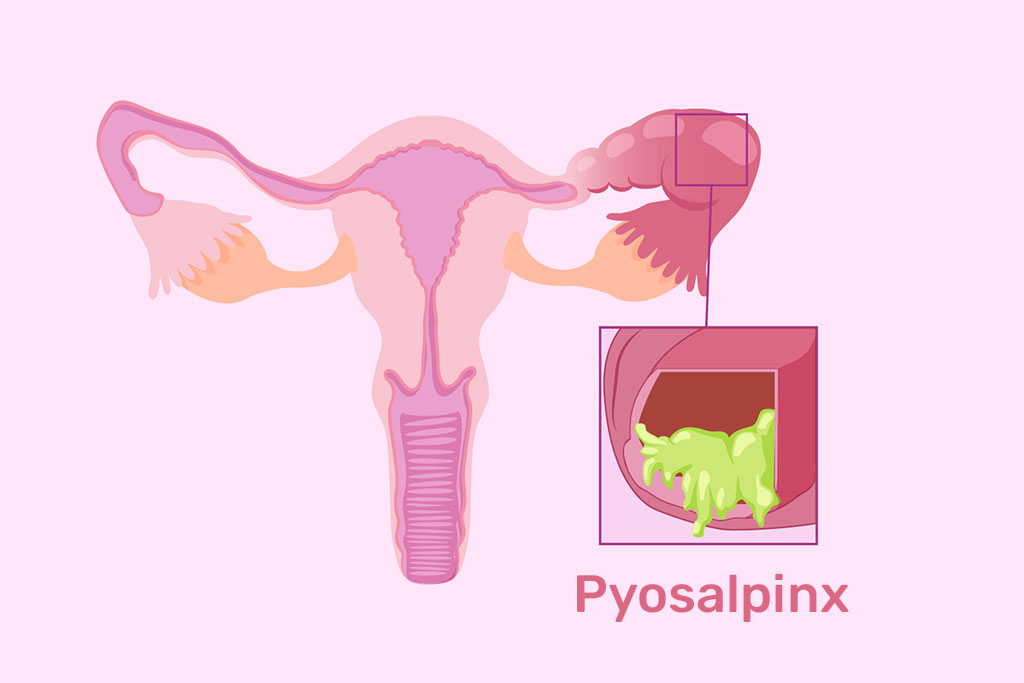 Pyosalpinx Causes Symptoms and Treatment