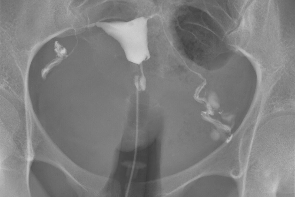 Understanding the HSG Procedure