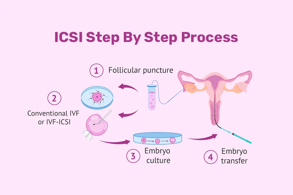 ICSI Treatment Step By Step Process