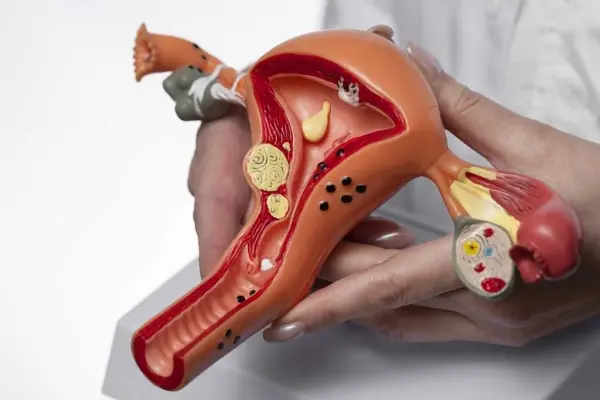 A Comprehensive Guide to Adenomyosis and Fibroids in Women’s Health