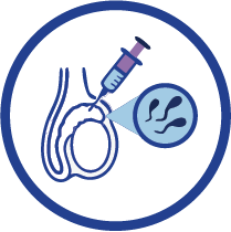 PESA sperm retrieval procedure for male infertility