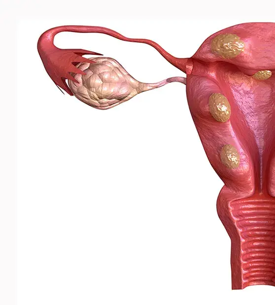 Fibroids