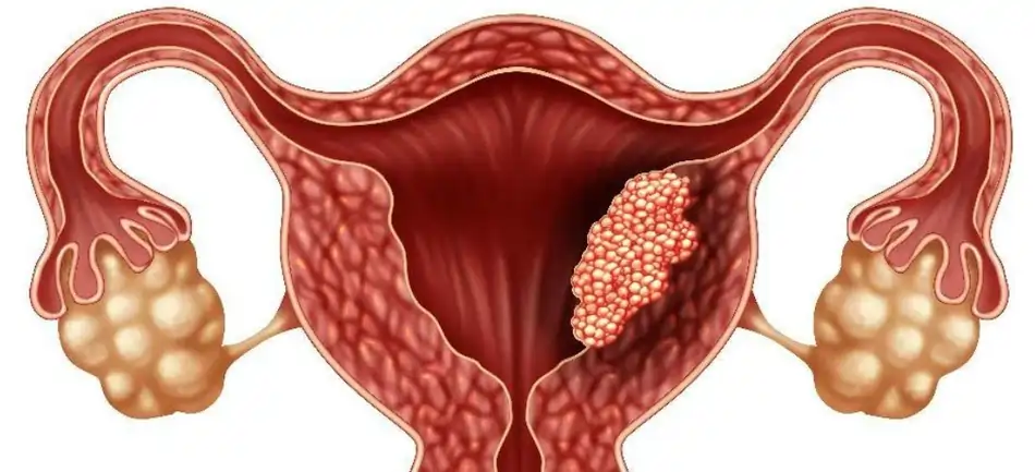 مشاكل العقم عند النساء