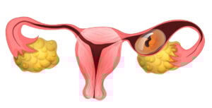 dis gebelik ektopik gebelik dis gebelik ektopik gebelik