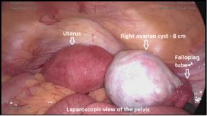 استئصال أكياس المبيض بالمنظار في الإمارات استئصال أكياس المبيض بالمنظار في الإمارات