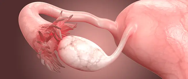 انسداد قناة فالوب والحمل