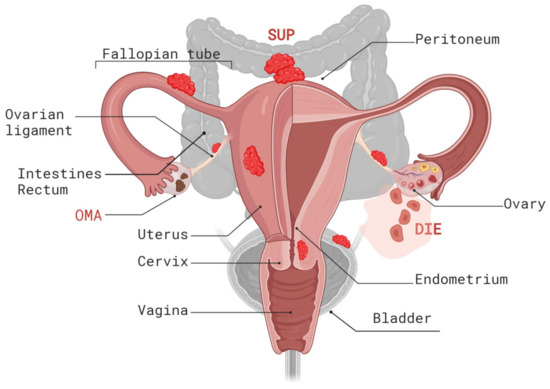 علاج الانتباذ البطاني الرحمي 2 علاج الانتباذ البطاني الرحمي 2