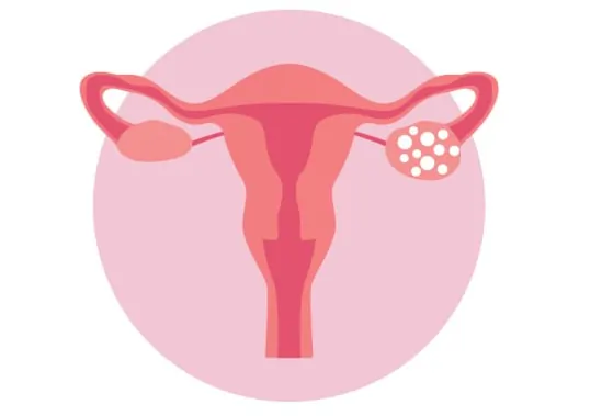 علاج متلازمة تكيس المبايض في دبي1