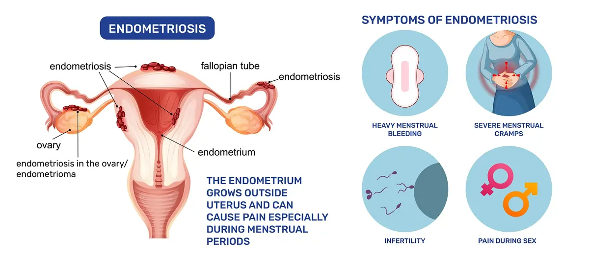 ENDOMETRIOSIS