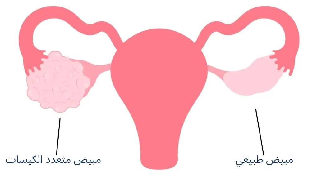 هل ينجح التلقيح الاصطناعي مع تكيس المبايض؟ نسب النجاح وأهم&hellip;