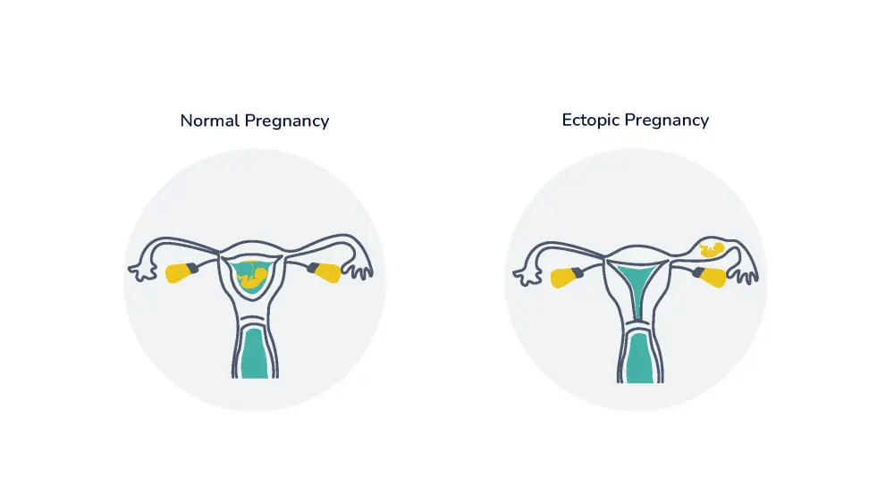 Ectopic Pregnancy