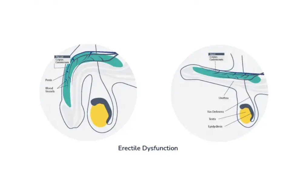 Erectile Dysfunction and Infertility