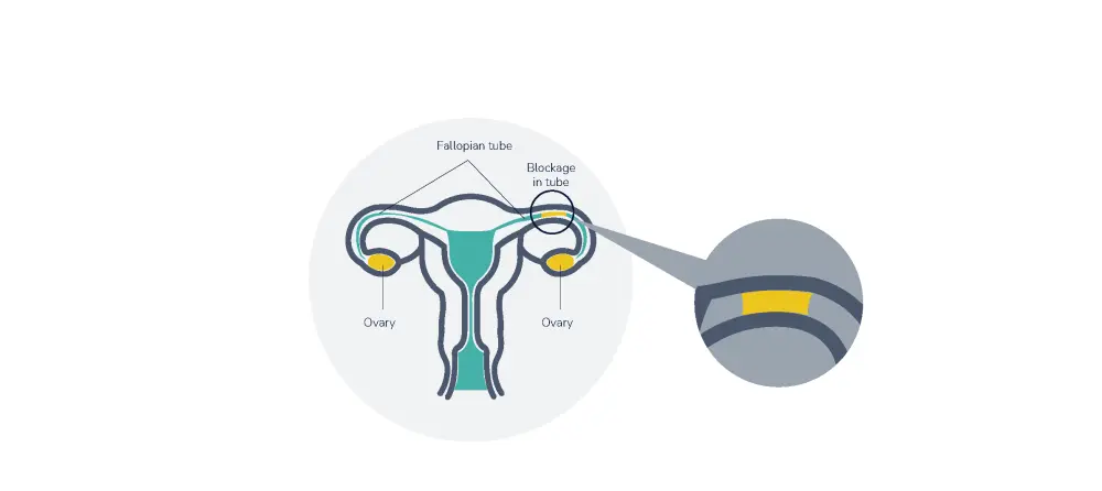 Fallopian Tube Blockage